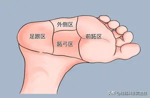 足底筋膜炎详解：症状、原因与治疗方法